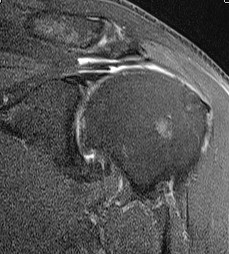 MRI Slap with SS tear